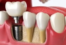 Dental Implant Newcastle