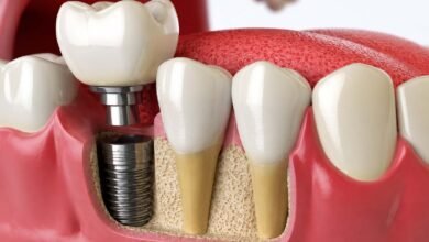 Dental Implant Newcastle