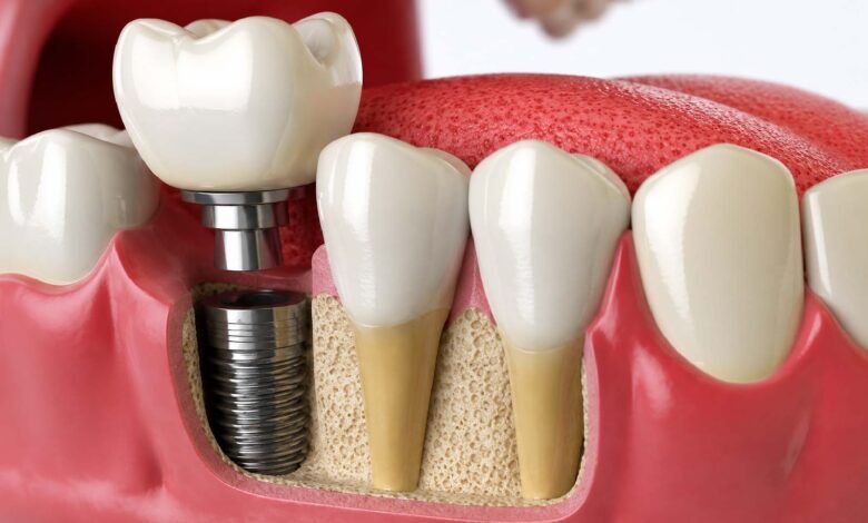 Dental Implant Newcastle