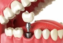 Dental implant treatment Newcastle