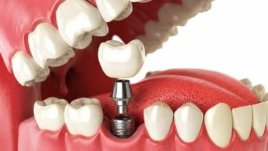 Dental implant treatment Newcastle