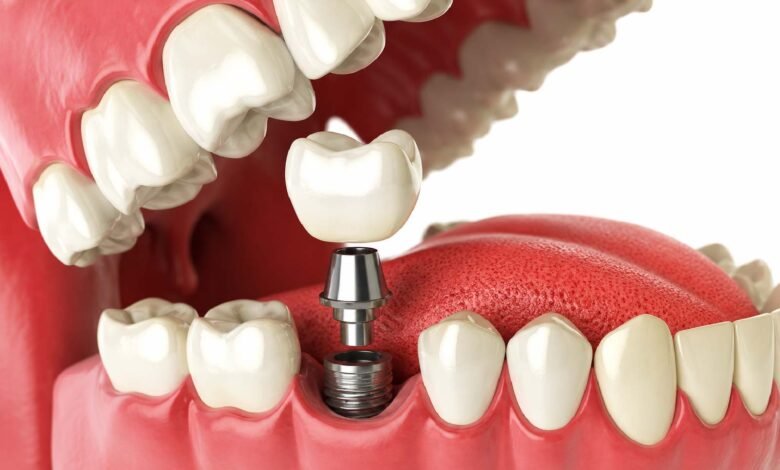 Dental implant treatment Newcastle