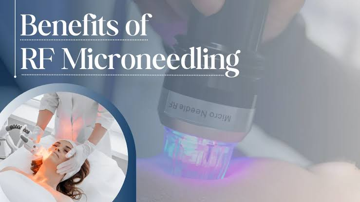 Discover the Transformative Benefits of RF Microneedling for Skin Rejuvenation